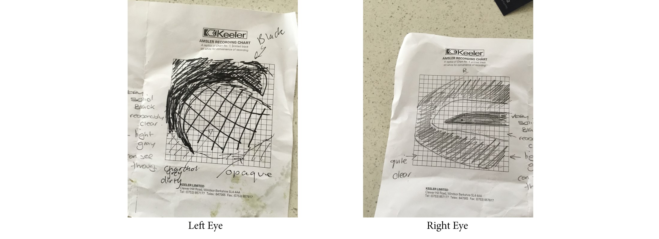 Image Description: The original drawing of my vision on a square grid. The left drawing has a black arc around most of the grid that gets lighter towards the bottom to represent my left eye.  The right drawing represents my right I. It is drawn in a bulls eye  effect.  There is a complete black spot in the centre of the grid which fades out and then back in.
